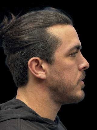 Chin Implant Before & After Gallery - Patient 300928 - Image 10