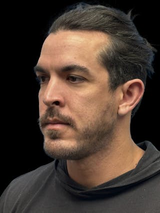 Chin Implant Before & After Gallery - Patient 300928 - Image 4