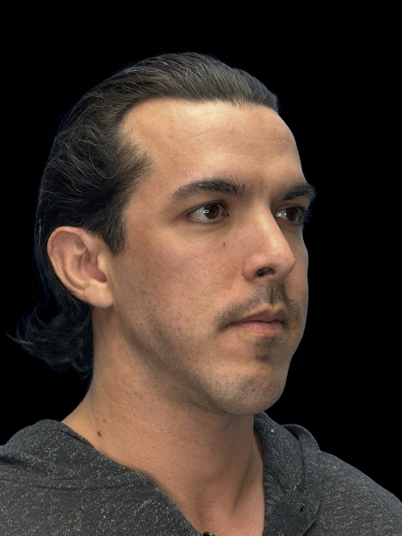 Chin Implant Before & After Gallery - Patient 300928 - Image 7