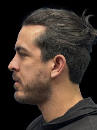 Chin Implant Before & After Gallery - Patient 300928 - Image 6