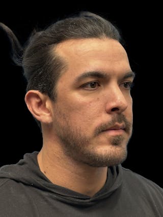 Chin Implant Before & After Gallery - Patient 300928 - Image 8