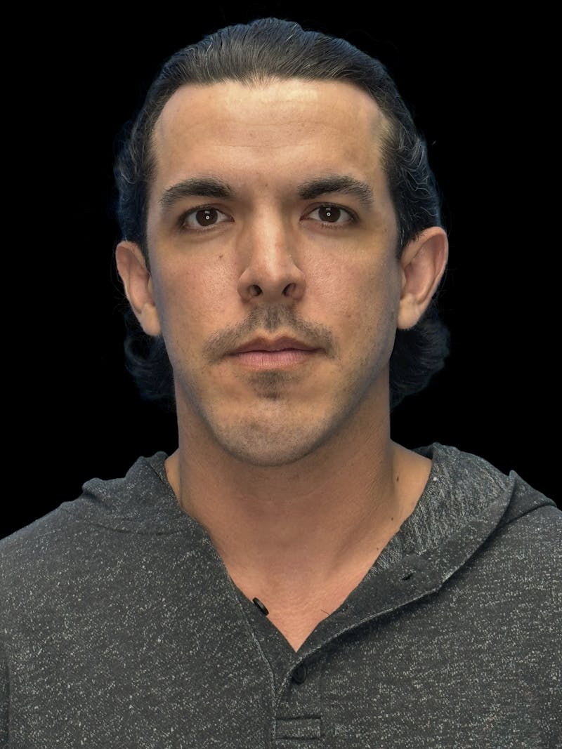 Chin Implant Before & After Gallery - Patient 300928 - Image 1