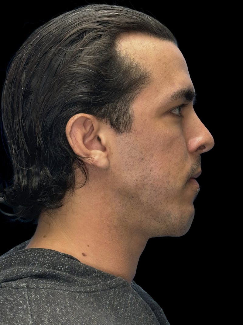 Chin Implant Before & After Gallery - Patient 300928 - Image 9