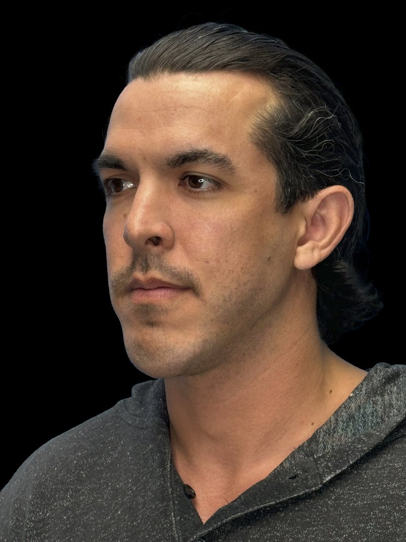 Chin Implant Before & After Gallery - Patient 300928 - Image 3