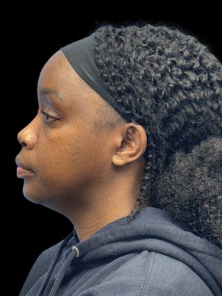 Chin Implant Before & After Gallery - Patient 153875 - Image 6