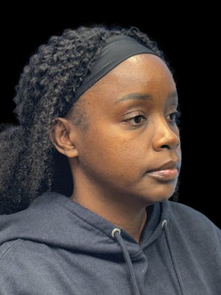 Chin Implant Before & After Gallery - Patient 153875 - Image 10