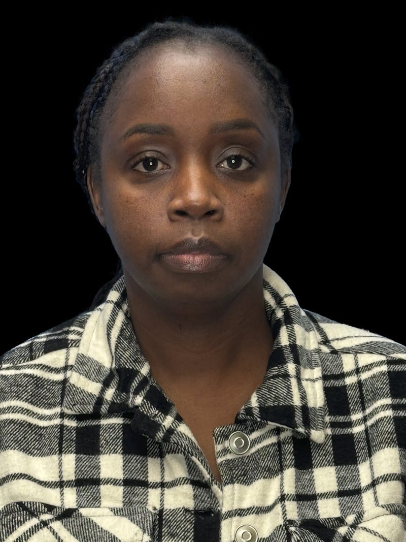 Chin Implant Before & After Gallery - Patient 153875 - Image 1