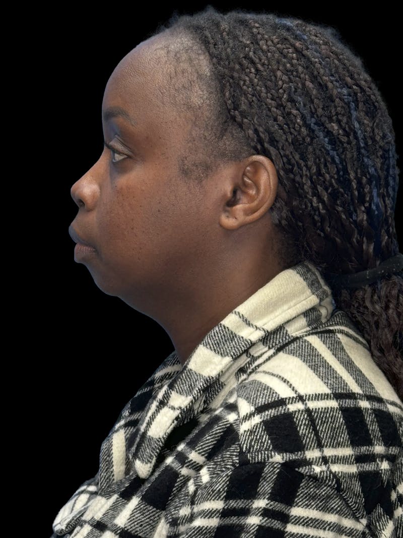 Chin Implant Before & After Gallery - Patient 153875 - Image 5