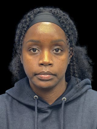 Chin Implant Before & After Gallery - Patient 153875 - Image 2