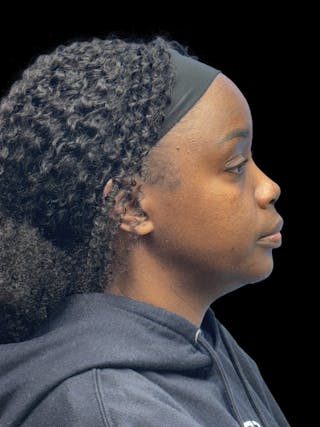 Chin Implant Before & After Gallery - Patient 153875 - Image 8