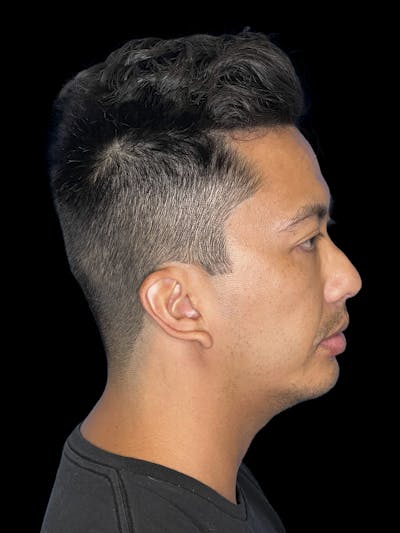 Chin Implant Before & After Gallery - Patient 410366 - Image 2