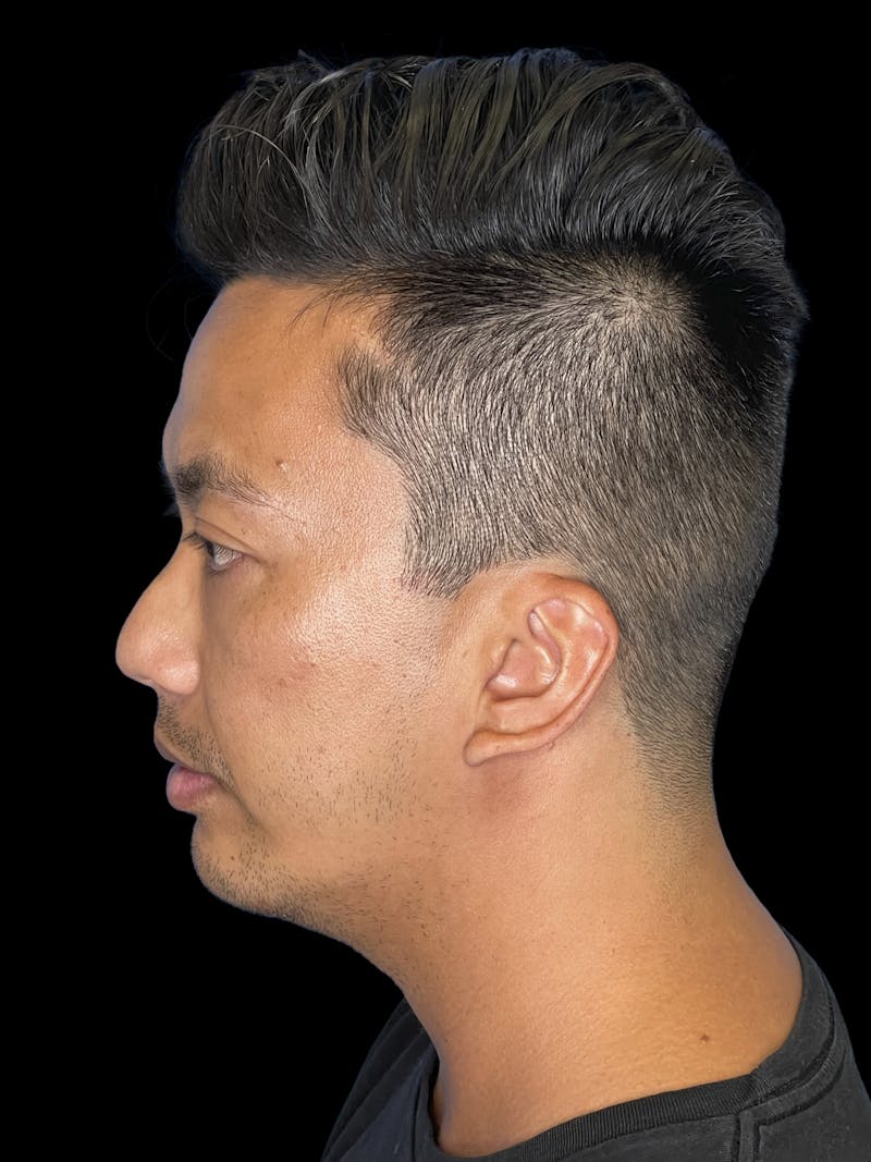 Chin Implant Before & After Gallery - Patient 410366 - Image 6