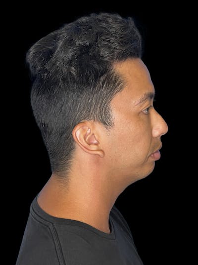 Chin Implant Before & After Gallery - Patient 410366 - Image 1