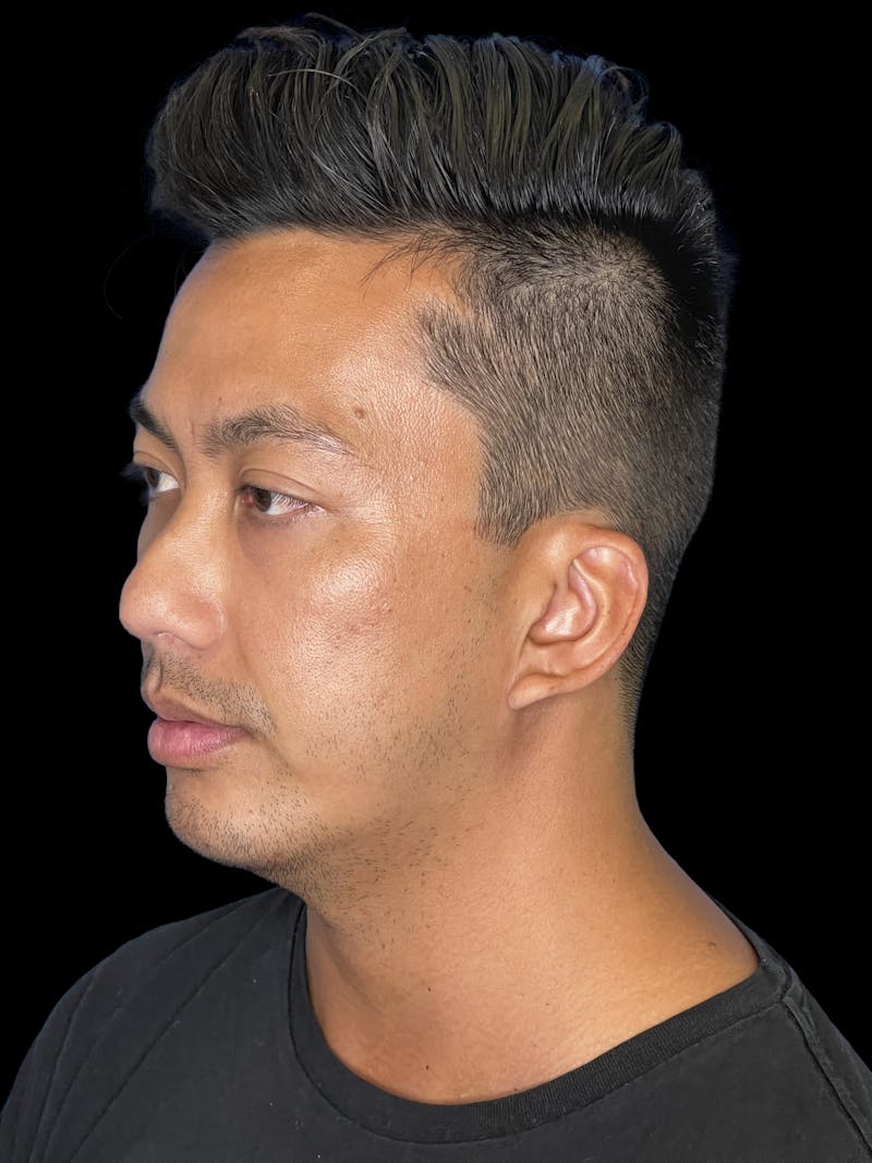 Chin Implant Before & After Gallery - Patient 410366 - Image 4