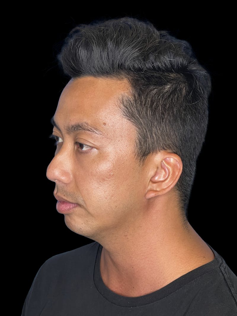 Chin Implant Before & After Gallery - Patient 410366 - Image 3
