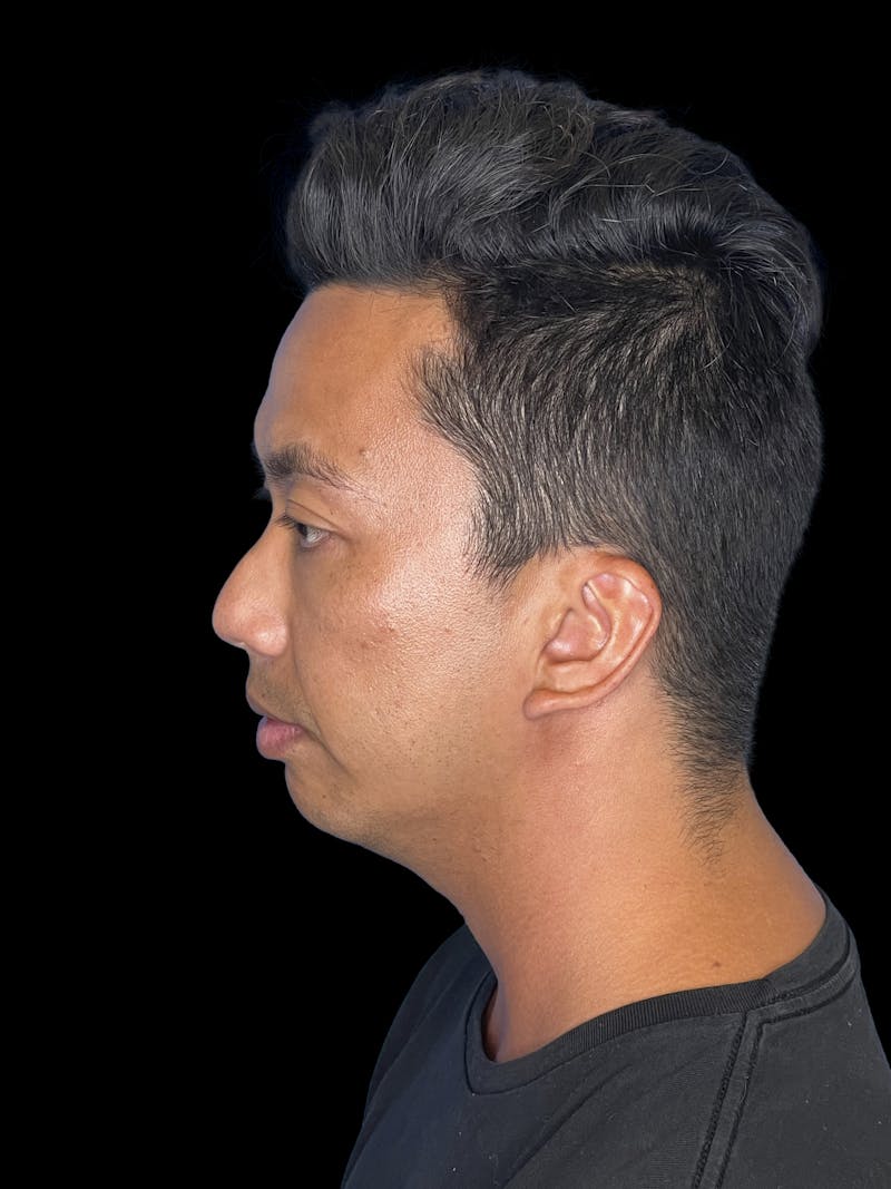 Chin Implant Before & After Gallery - Patient 410366 - Image 5