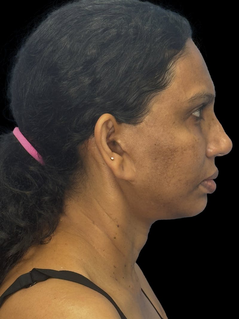 Chin Implant Before & After Gallery - Patient 402609 - Image 5