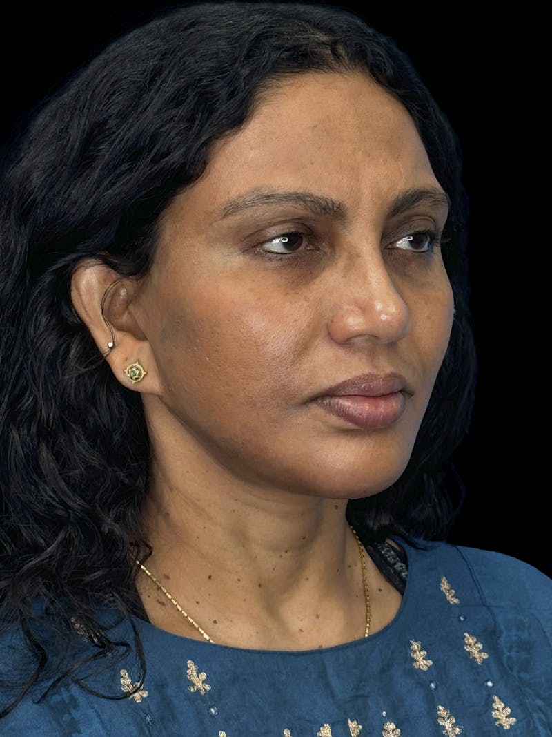 Chin Implant Before & After Gallery - Patient 402609 - Image 2