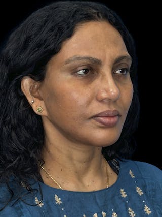 Chin Implant Before & After Gallery - Patient 402609 - Image 2