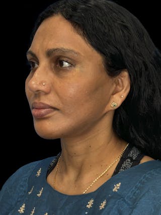 Chin Implant Before & After Gallery - Patient 402609 - Image 4