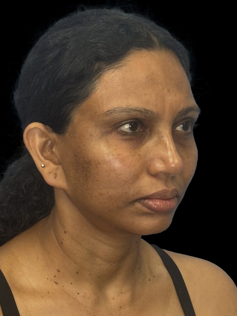 Chin Implant Before & After Gallery - Patient 402609 - Image 1