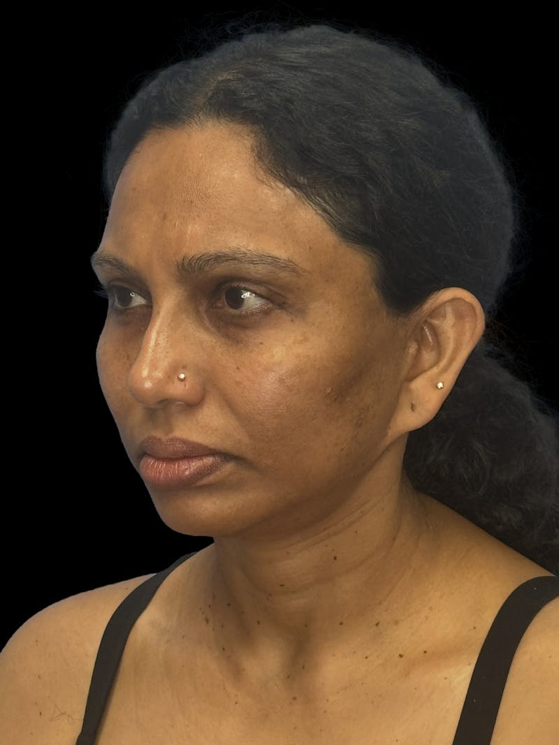 Chin Implant Before & After Gallery - Patient 402609 - Image 3
