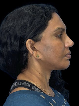 Chin Implant Before & After Gallery - Patient 402609 - Image 6