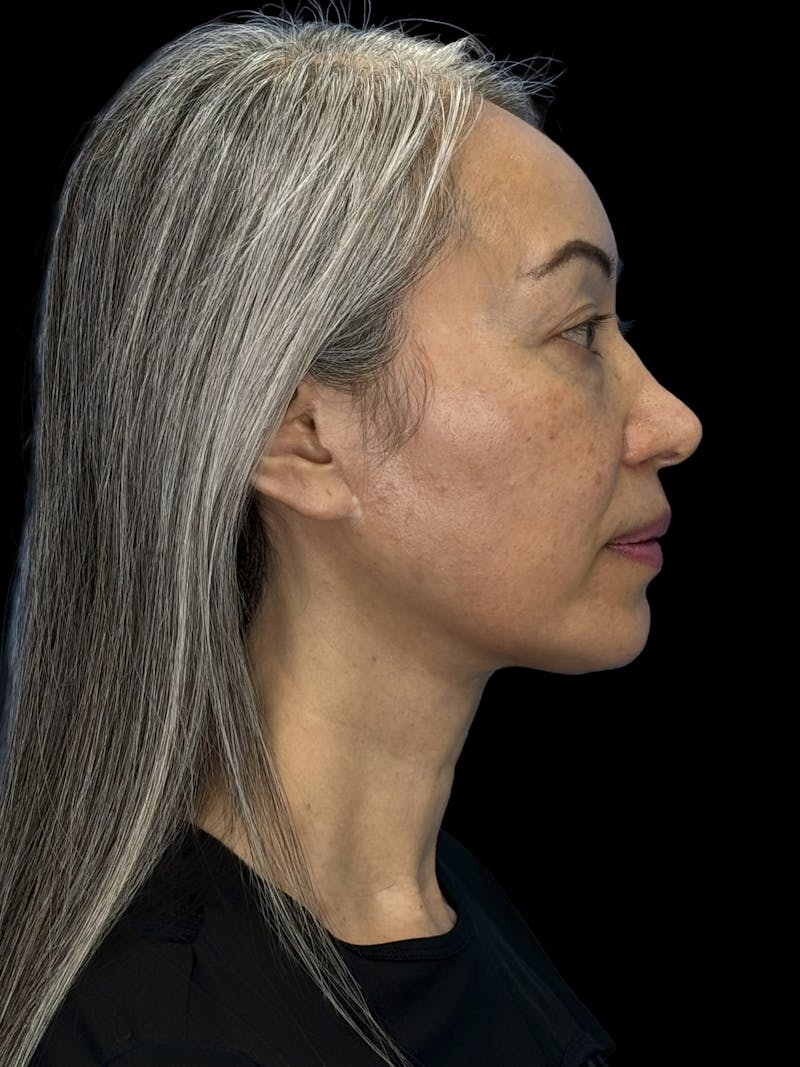 Chin Implant Before & After Gallery - Patient 127068 - Image 10