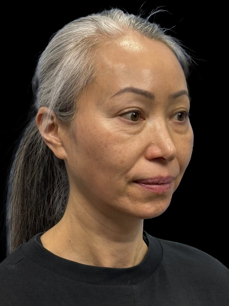 Chin Implant Before & After Gallery - Patient 127068 - Image 5