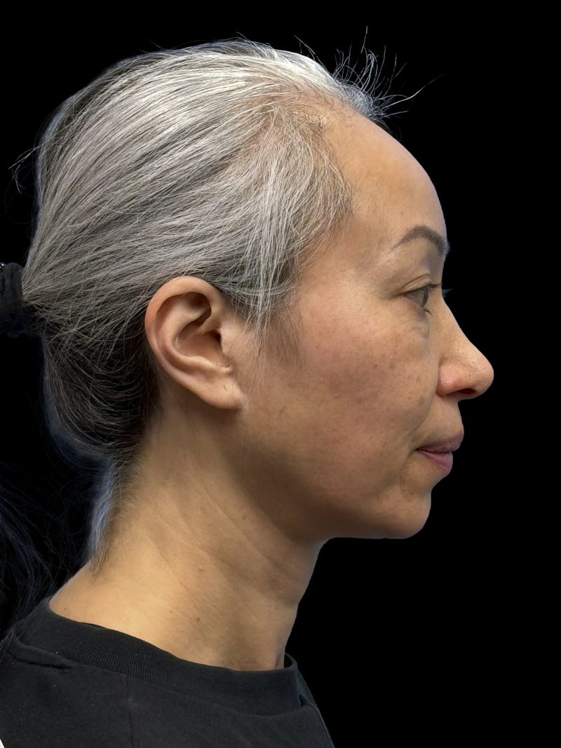 Chin Implant Before & After Gallery - Patient 127068 - Image 9