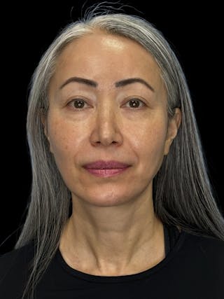 Chin Implant Before & After Gallery - Patient 127068 - Image 2