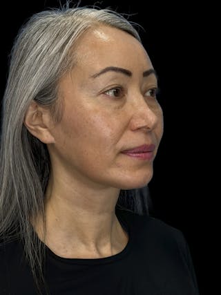 Chin Implant Before & After Gallery - Patient 127068 - Image 6
