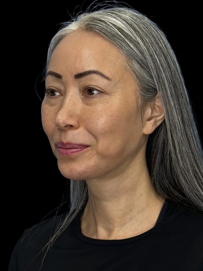 Chin Implant Before & After Gallery - Patient 127068 - Image 4