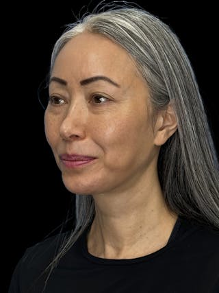 Chin Implant Before & After Gallery - Patient 127068 - Image 4