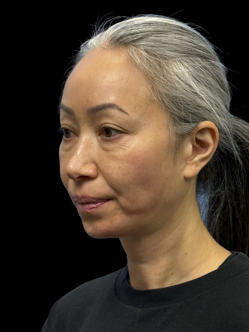 Chin Implant Before & After Gallery - Patient 127068 - Image 3