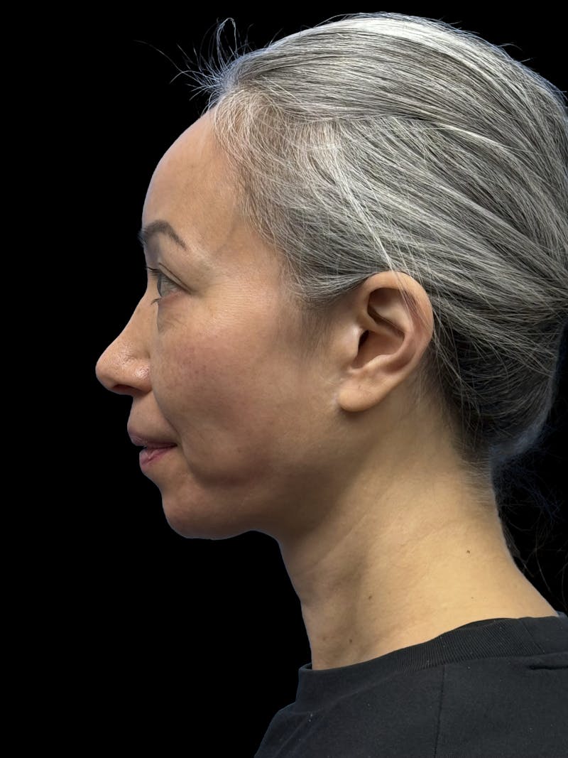 Chin Implant Before & After Gallery - Patient 127068 - Image 7