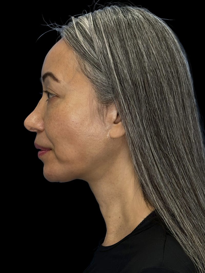 Chin Implant Before & After Gallery - Patient 127068 - Image 8