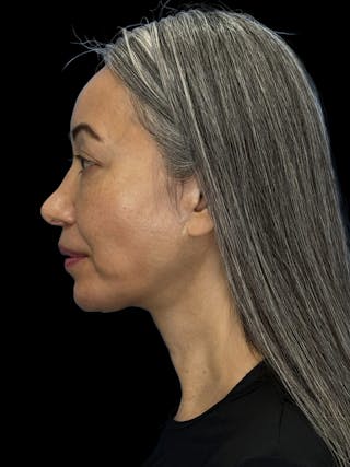 Chin Implant Before & After Gallery - Patient 127068 - Image 8