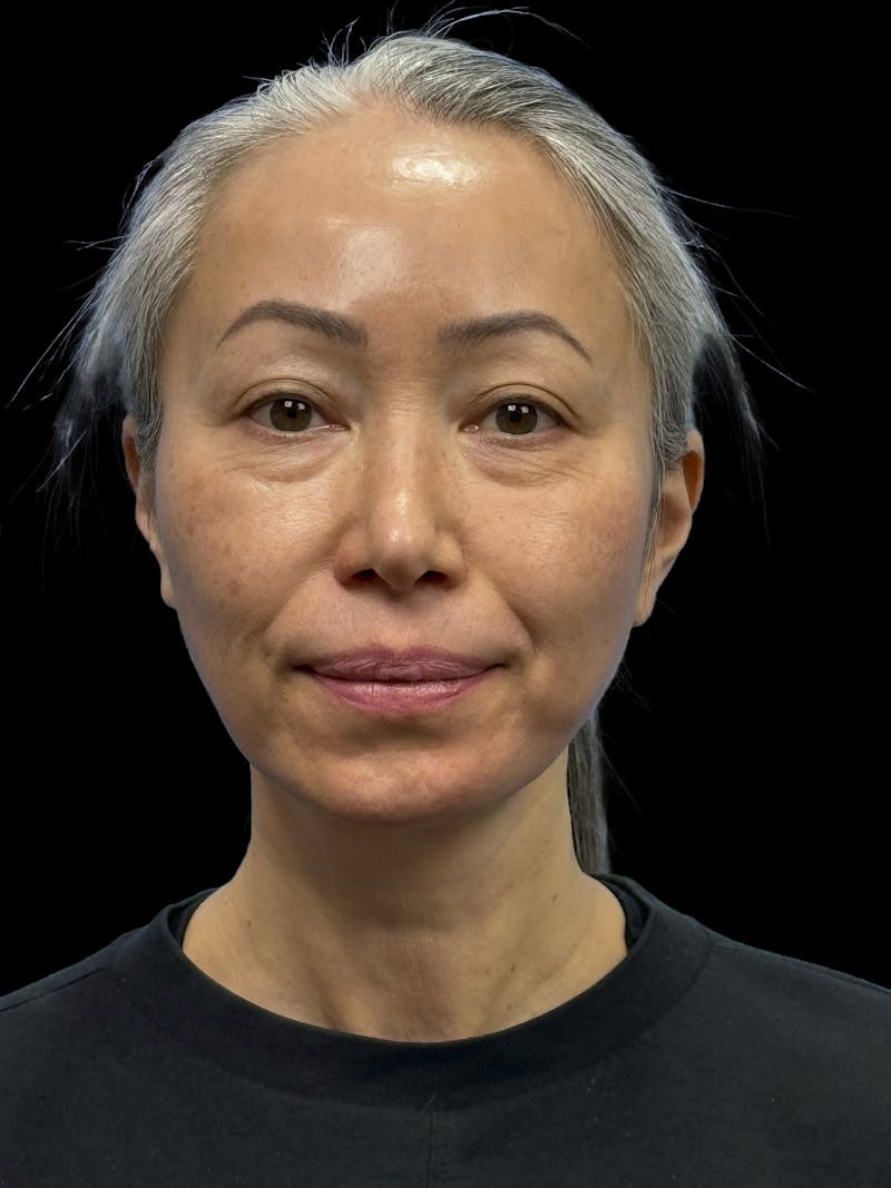 Chin Implant Before & After Gallery - Patient 127068 - Image 1