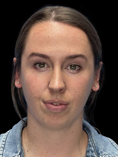 Chin Implant Before & After Gallery - Patient 207240 - Image 1