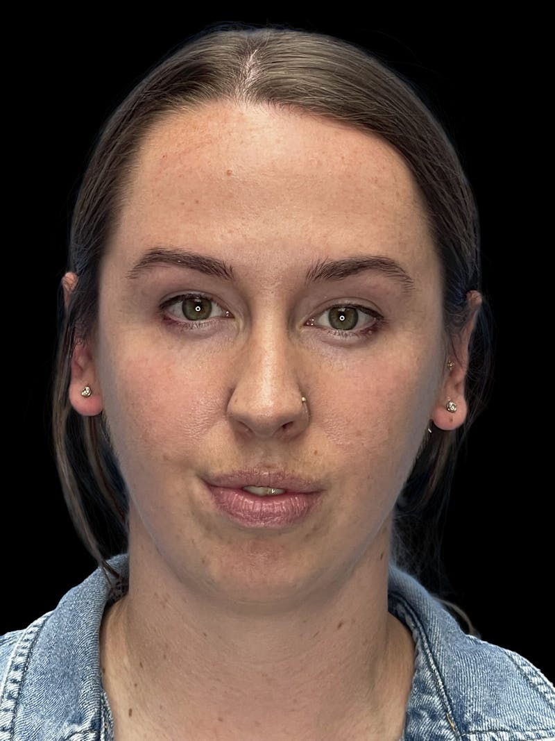 Chin Implant Before & After Gallery - Patient 207240 - Image 1