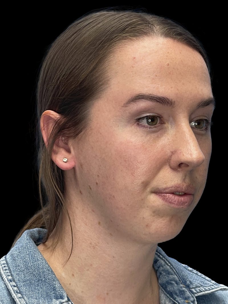 Chin Implant Before & After Gallery - Patient 207240 - Image 3