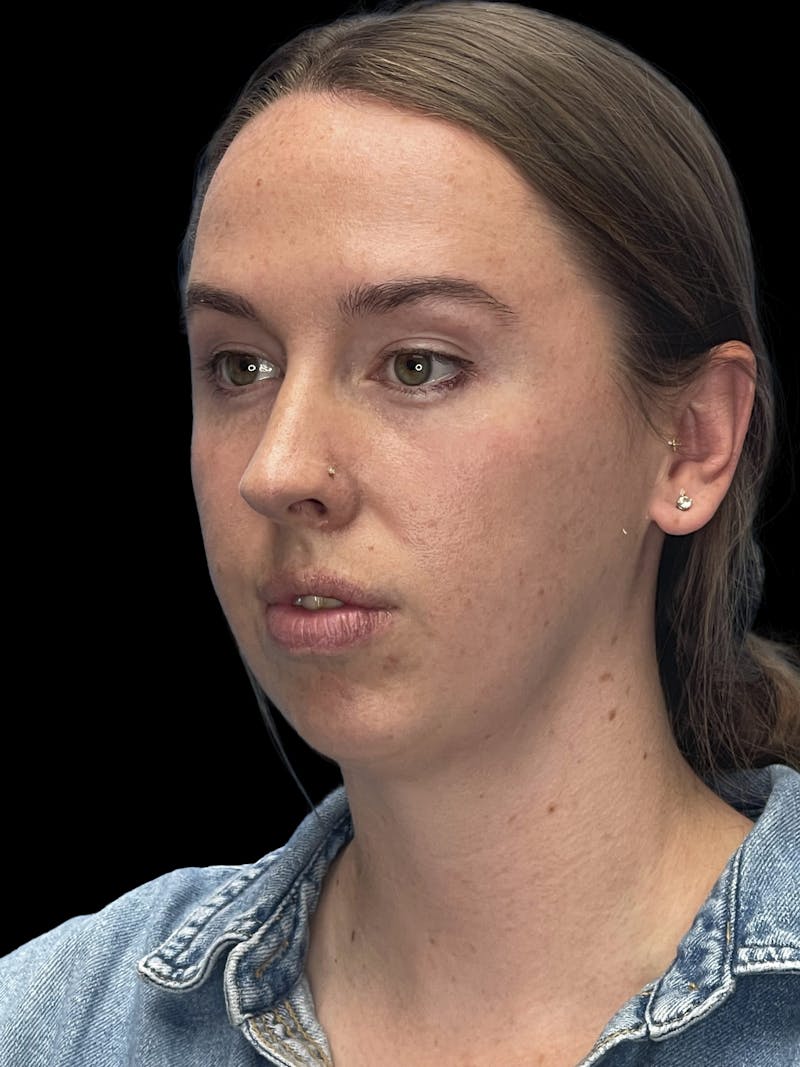 Chin Implant Before & After Gallery - Patient 207240 - Image 5