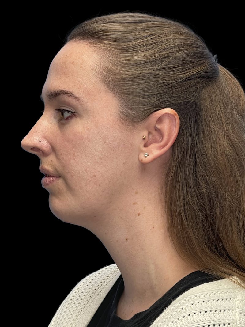 Chin Implant Before & After Gallery - Patient 207240 - Image 8
