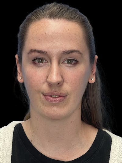 Chin Implant Before & After Gallery - Patient 207240 - Image 2