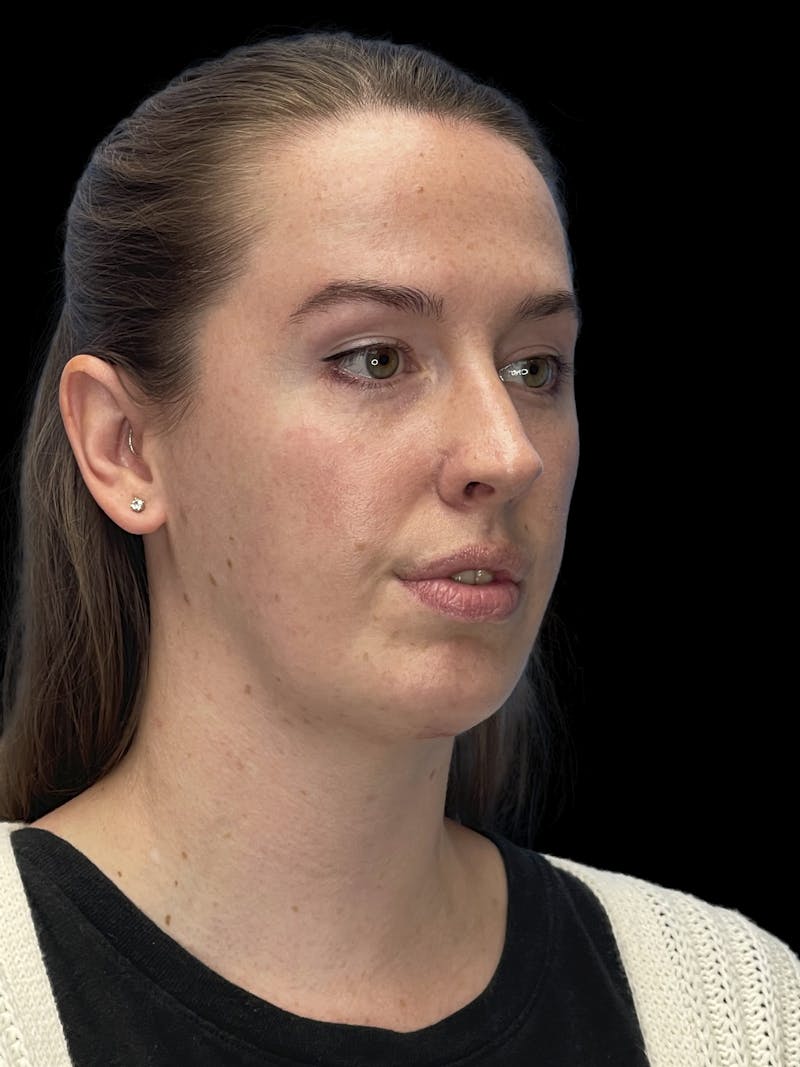 Chin Implant Before & After Gallery - Patient 207240 - Image 4