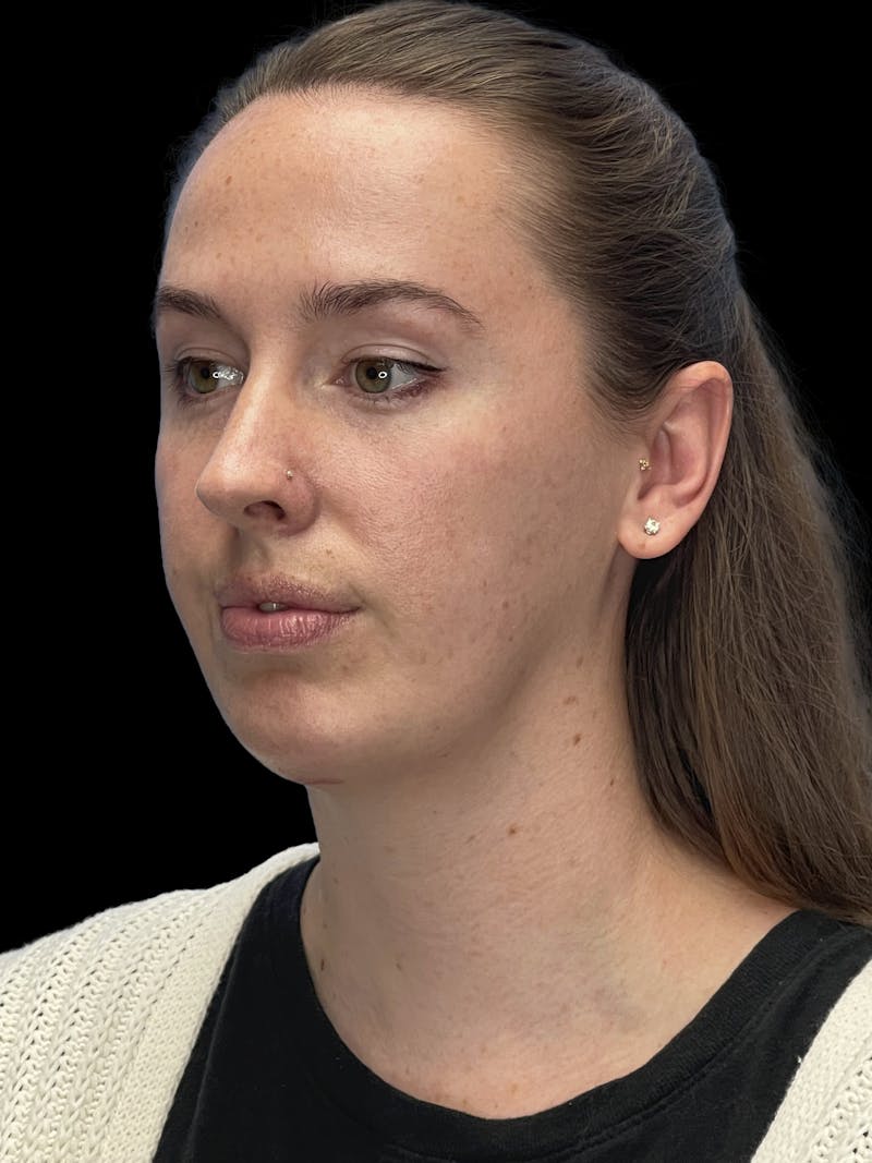 Chin Implant Before & After Gallery - Patient 207240 - Image 6