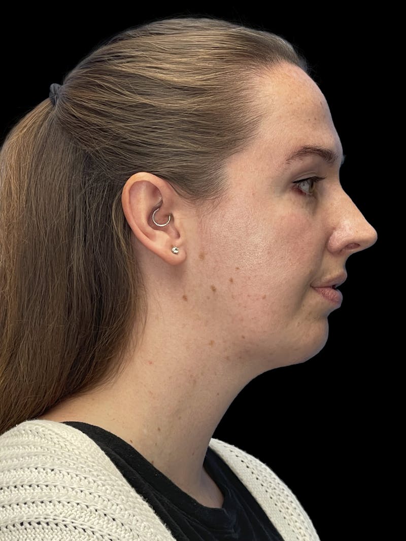 Chin Implant Before & After Gallery - Patient 207240 - Image 10