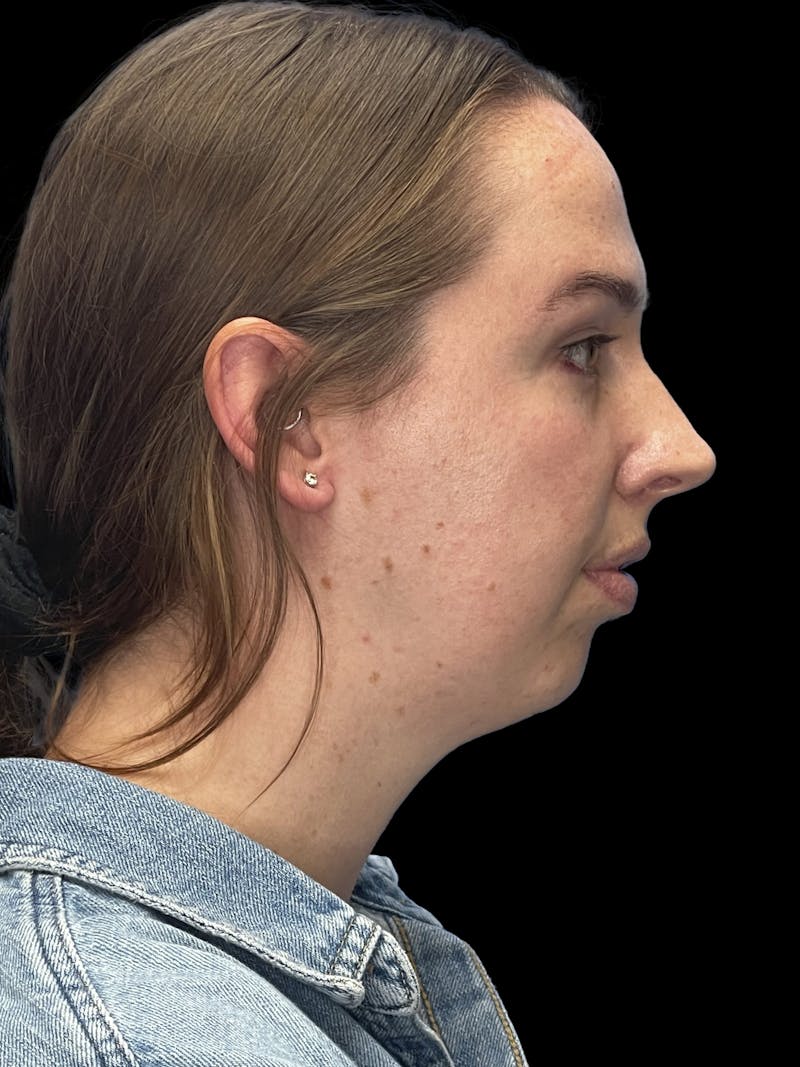 Chin Implant Before & After Gallery - Patient 207240 - Image 9