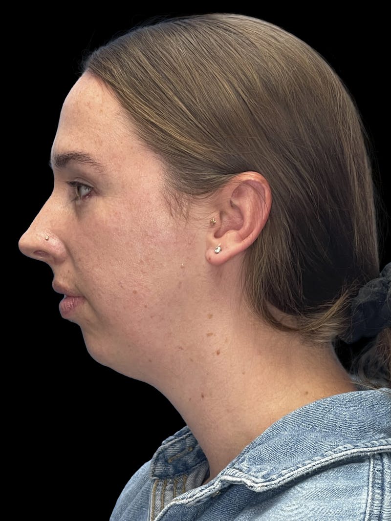 Chin Implant Before & After Gallery - Patient 207240 - Image 7